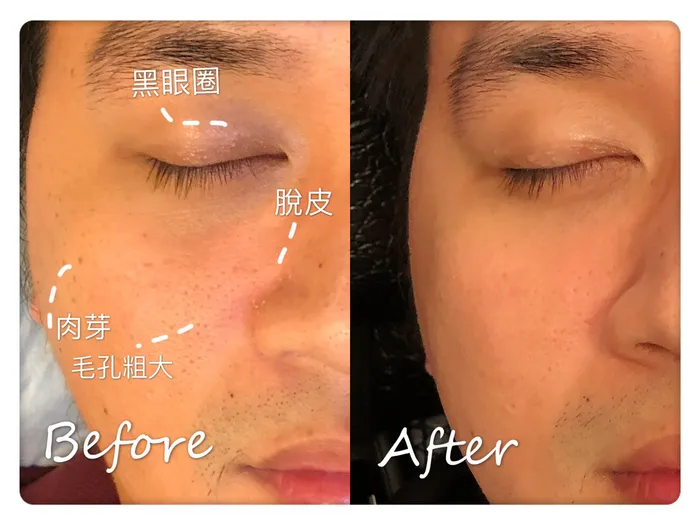 皮膚管理案例 4